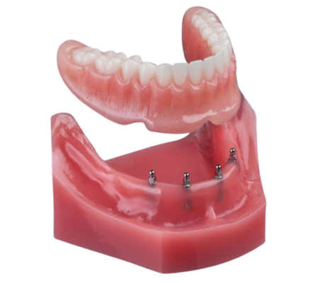 Snap In Denture in Melbourne FL | Book Your Free Consultation!